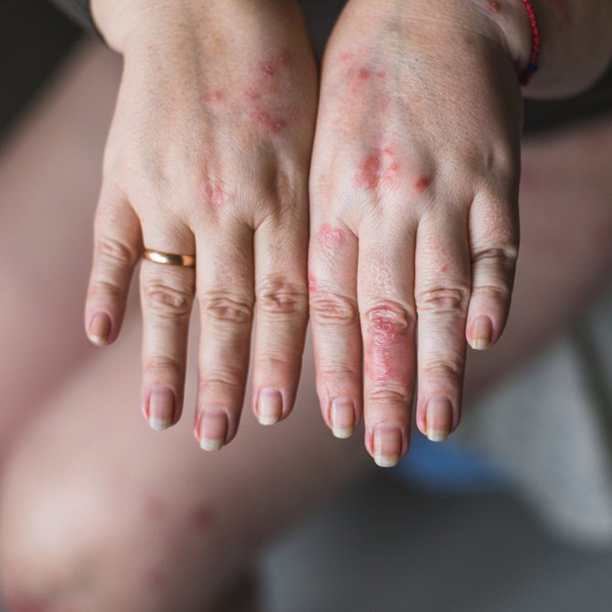 Woman showing off her hands that have inflammation