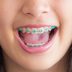 10 Foods to Avoid with Braces